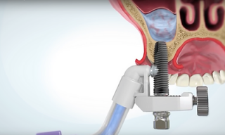 dental implantology courses montreal Raviv Dental