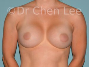 breast enlargement clinics montreal Breast Augmentation Montreal