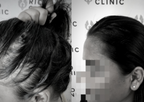 clinics hair transplant clinics montreal RICO CLINIC SCALP MICROPIGMENTATION MONTREAL