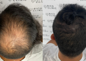 clinics hair transplant clinics montreal RICO CLINIC SCALP MICROPIGMENTATION MONTREAL