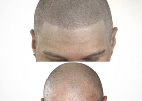 facebook specialists montreal RICO CLINIC SCALP MICROPIGMENTATION MONTREAL