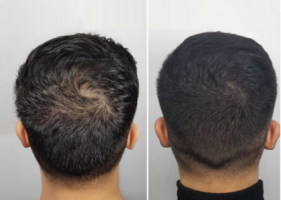 facebook specialists montreal RICO CLINIC SCALP MICROPIGMENTATION MONTREAL
