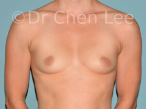 plastic surgeons in montreal Breast Augmentation Montreal