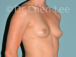 plastic surgeons in montreal Breast Augmentation Montreal