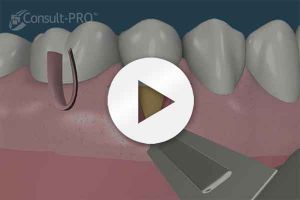 cours d implantologie dentaire montreal Clinique de Parodontie et d'implantologie du Plateau