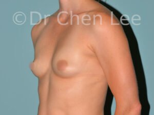 plastic surgeons in breast augmentation in montreal Breast Augmentation Montreal